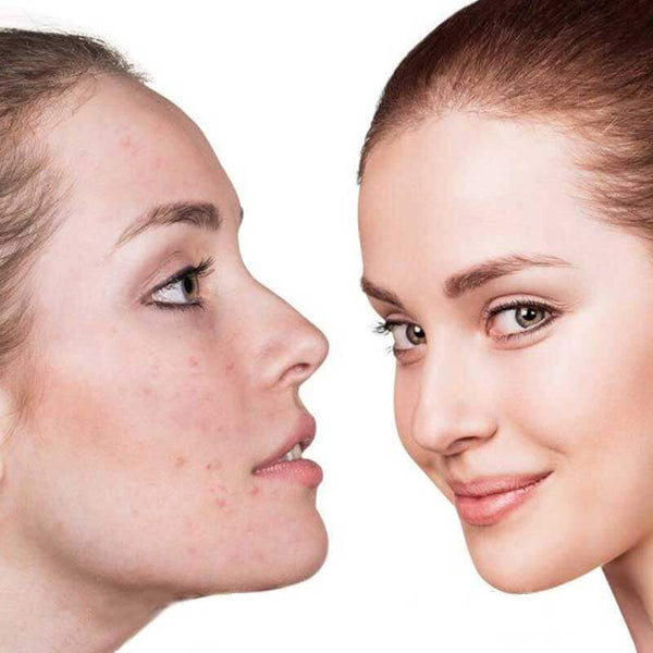 5 in 1 LED Skin Treatment Handset